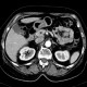Angiomyolipoma of kidney, small: CT - Computed tomography